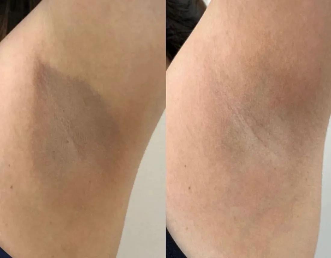 Aclaramiento de axila — antes y después