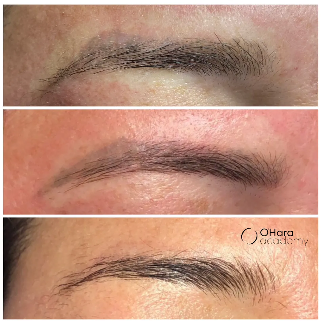 Reconstrucción de cejas — antes y después