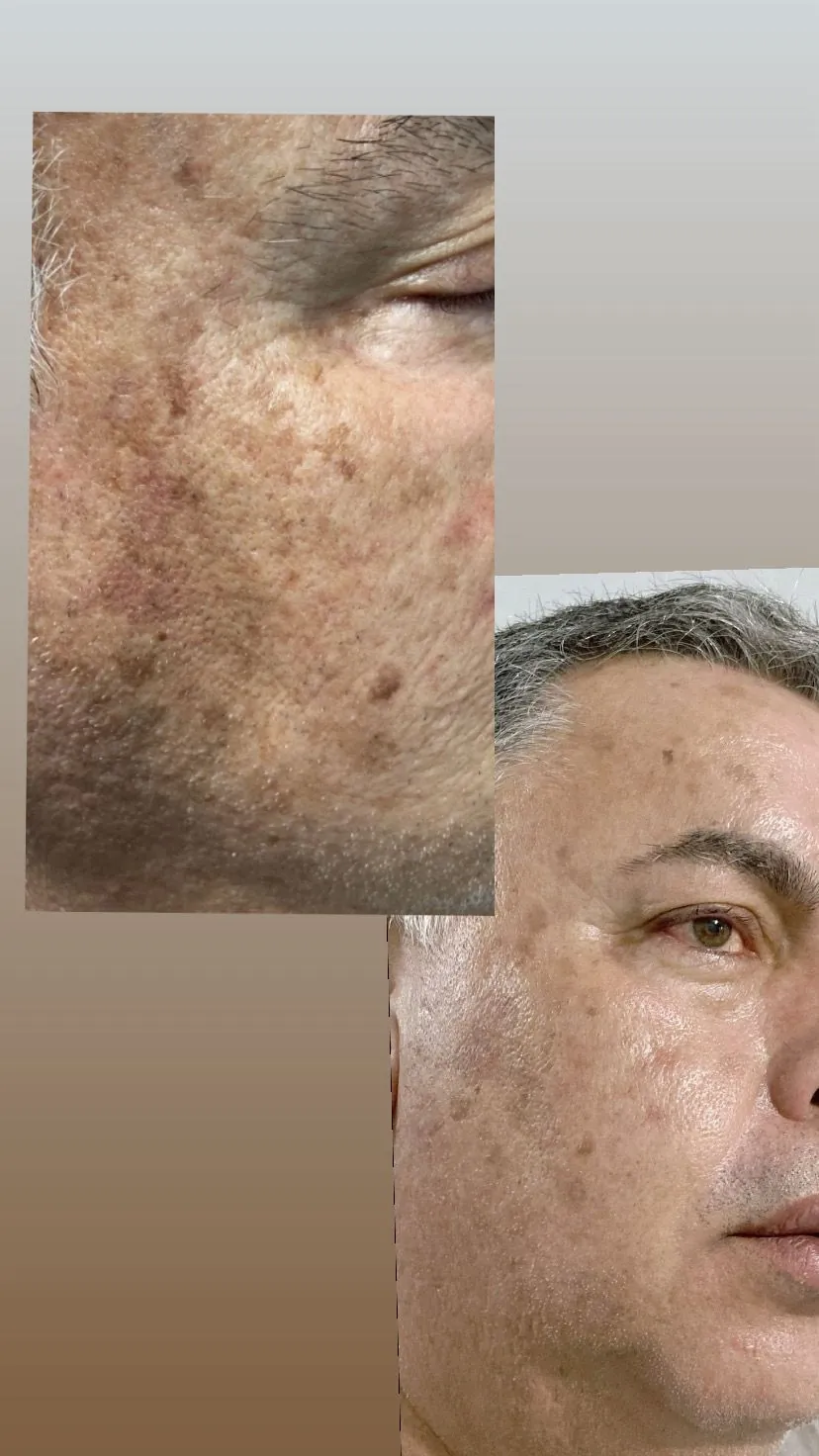 Cicatrices — antes y después