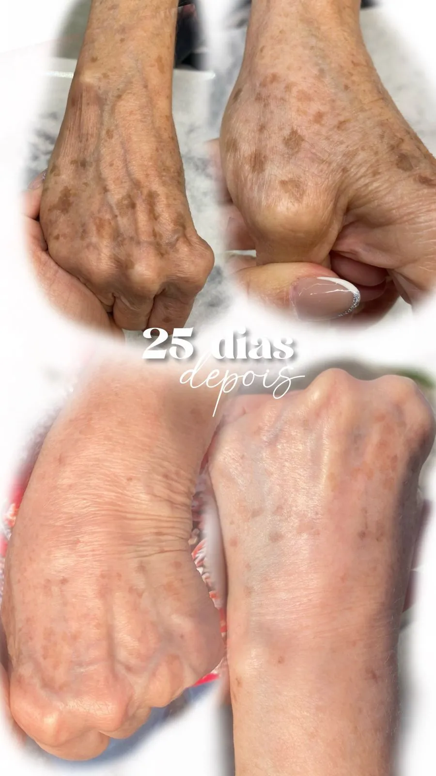 Melanosis en manos — antes y después