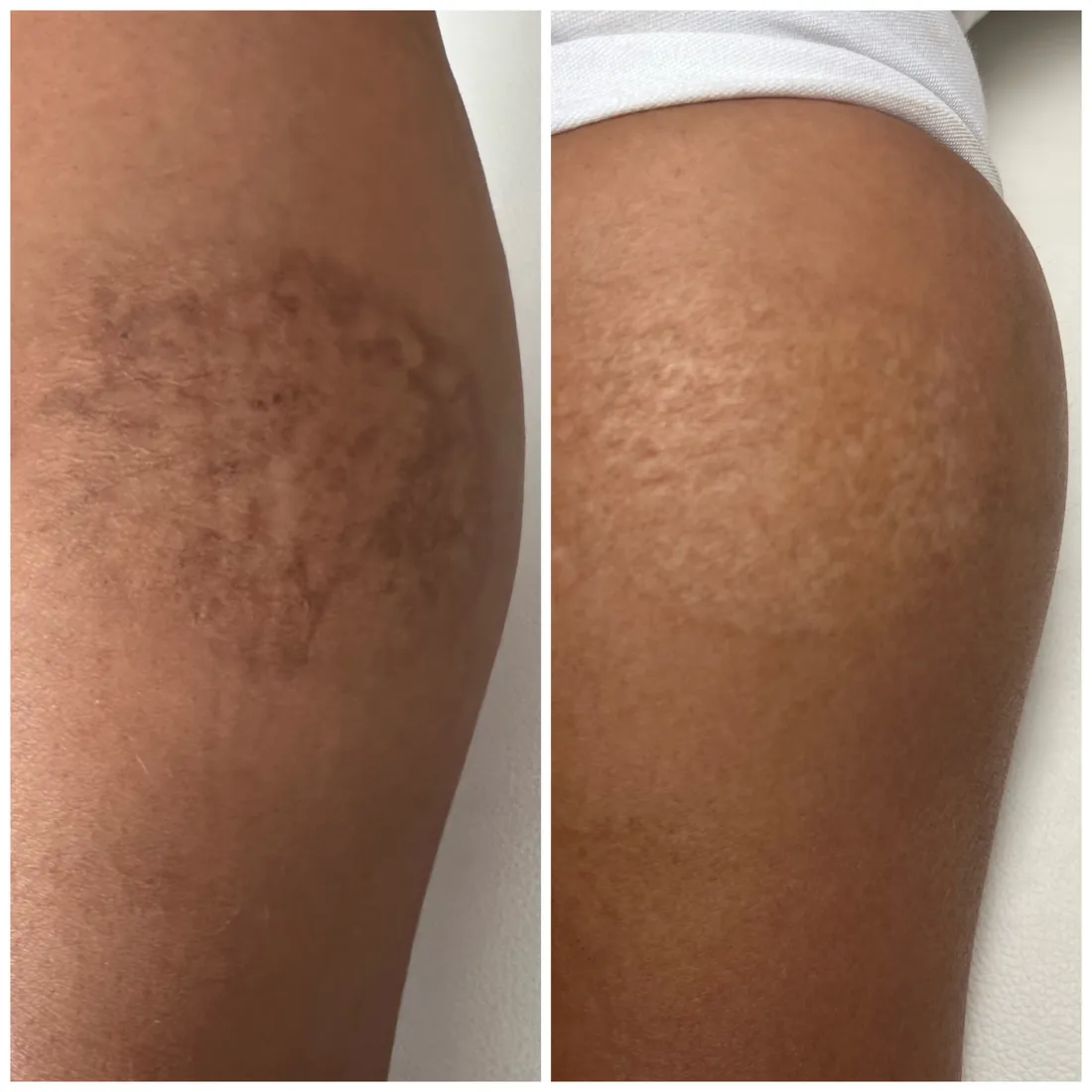 Melasma — antes y después