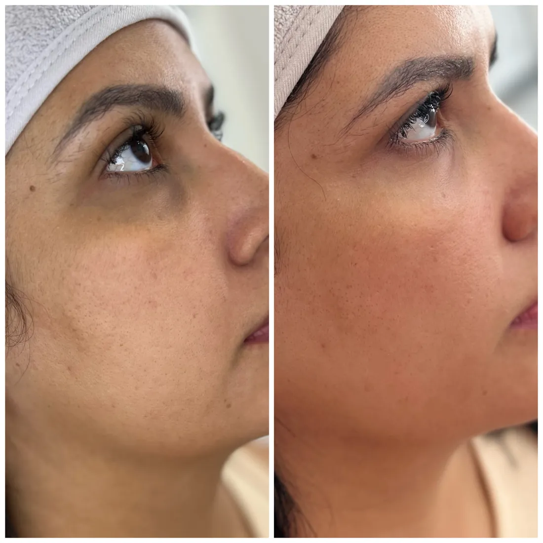 Aclaramiento de ojeras — antes y después