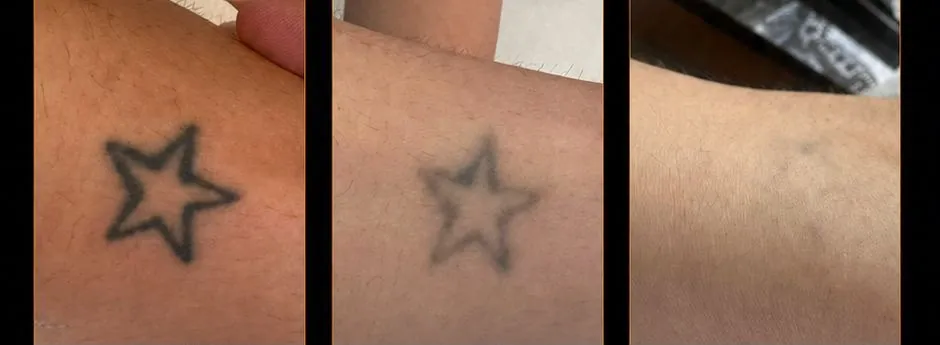 Remoción de tatuaje — antes y después